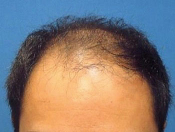 薄毛治療 発毛症例 36歳/MO型/初診時