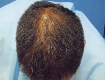 薄毛治療 発毛症例 41歳/O型/初診時