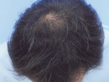 薄毛治療 発毛症例 37歳/O型/12ヶ月後