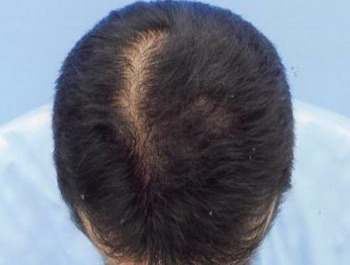 薄毛治療 発毛症例 42歳/MO型/5ヶ月後
