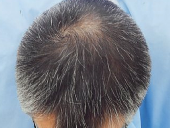 薄毛治療 発毛症例 44歳/O型/9ヶ月後
