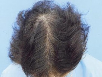 薄毛治療 発毛症例 62歳/全体/9ヶ月後