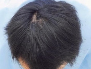 薄毛治療 発毛症例 24歳/MO型/6ヶ月後