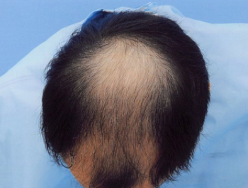 薄毛治療 発毛症例 33歳/MO型/初診時