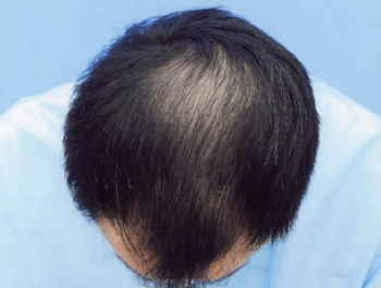 薄毛治療 発毛症例 33歳/MO型/10ヶ月後