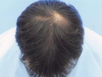 薄毛治療 発毛症例 32歳/O型/初診時