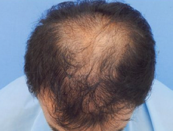 薄毛治療 発毛症例 41歳/MO型/初診時