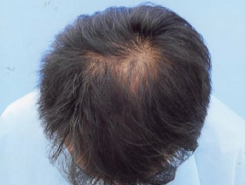 薄毛治療 発毛症例 41歳/MO型/12ヶ月後