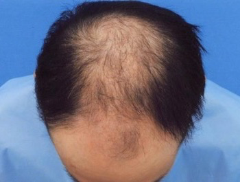 薄毛治療 発毛症例 37歳/MO型/初診時