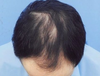 薄毛治療 発毛症例 37歳/MO型/6ヶ月後