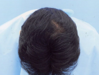 薄毛治療 発毛症例 45歳/MO型/6ヶ月後