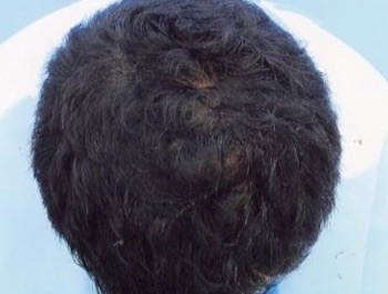 薄毛治療 発毛症例 34歳/O型/6ヶ月後