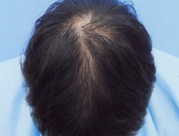 薄毛治療 発毛症例 28歳/O型/6ヶ月後