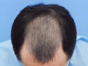 薄毛治療 発毛症例 46歳/MO型/初診時