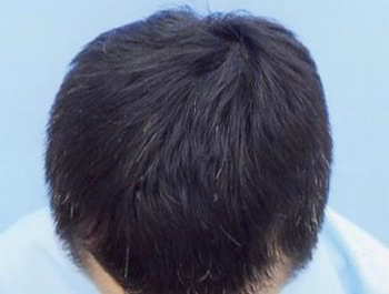 薄毛治療 発毛症例 46歳/MO型/5ヶ月後