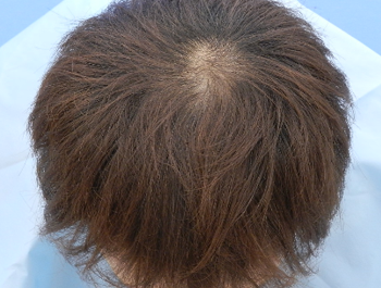 薄毛治療 発毛症例 28歳/O型/12ヶ月後