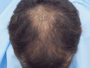 薄毛治療 発毛症例 29歳/O型/初診時