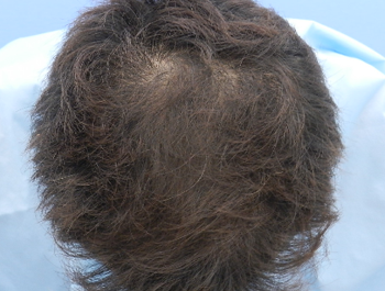 薄毛治療 発毛症例 29歳/O型/12ヶ月後