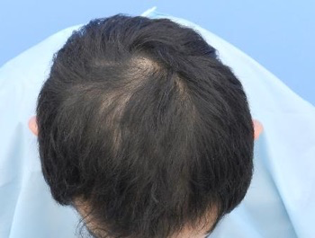 薄毛治療 発毛症例 35歳/O型/8ヶ月後