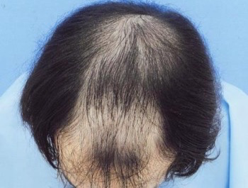 薄毛治療 発毛症例 23歳/MO型/初診時