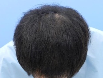 薄毛治療 発毛症例 23歳/MO型/5ヶ月後