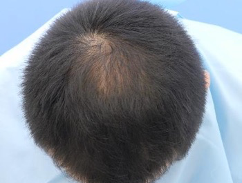 薄毛治療 発毛症例 36歳/O型/5ヶ月後