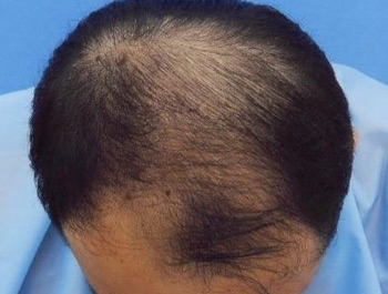 薄毛治療 発毛症例 26歳/MO型/初診時
