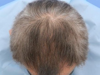 薄毛治療 発毛症例 48歳/MO型/7ヶ月後