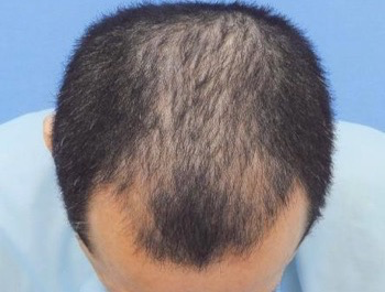 薄毛治療 発毛症例 45歳/MO型/初診時