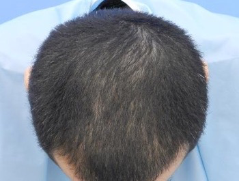 薄毛治療 発毛症例 45歳/MO型/7ヶ月後