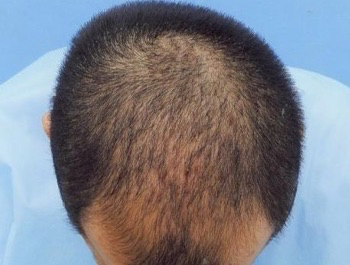 薄毛治療 発毛症例 25歳/MO型/初診時