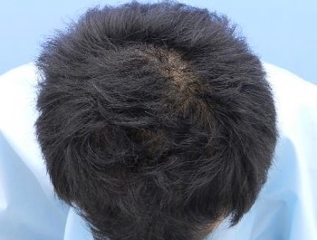 薄毛治療 発毛症例 25歳/MO型/6ヶ月後