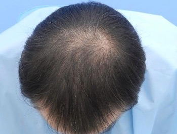 AGA治療例:40歳/O型/薄毛歴10年//3ヶ月後