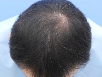 AGA治療例:40歳/O型/薄毛歴10年//5ヶ月後