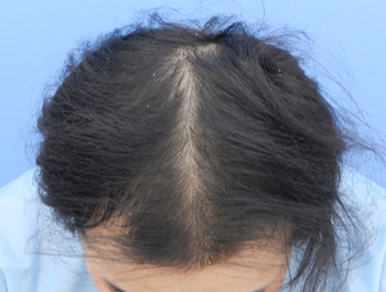 薄毛治療 発毛症例 25歳/MO型/11ヶ月後