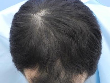 薄毛治療 発毛症例 35歳/MO型/7ヶ月後