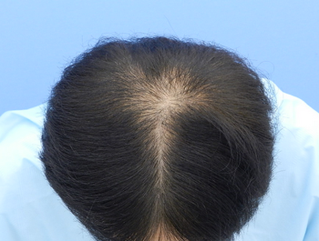 薄毛治療 発毛症例 53歳/MO型/12ヶ月後