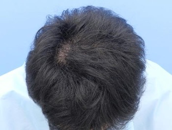 薄毛治療 発毛症例 25歳/O型/6ヶ月後