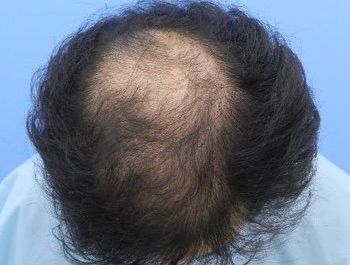 薄毛治療 発毛症例 27歳/O型/初診時