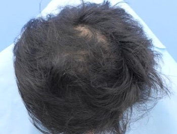 薄毛治療 発毛症例 27歳/O型/6ヶ月後