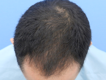 薄毛治療 発毛症例 36歳/MO型/9ヶ月後