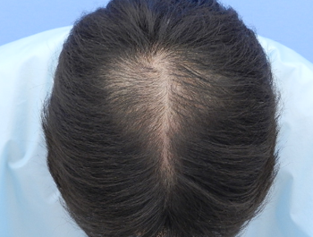 薄毛治療 発毛症例 38歳/O型/8ヶ月後