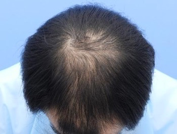 薄毛治療 発毛症例 39歳/O型/初診時