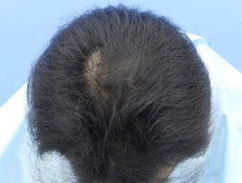 薄毛治療 発毛症例 39歳/O型/5ヶ月後