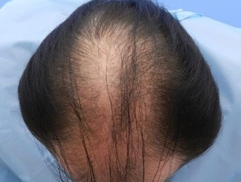 薄毛治療 発毛症例 56歳/MO型/初診時
