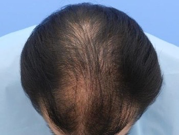 薄毛治療 発毛症例 56歳/MO型/7ヶ月後