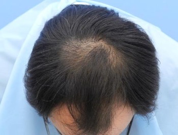 薄毛治療 発毛症例 37歳/O型/初診時