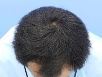 薄毛治療 発毛症例 37歳/O型/6ヶ月後