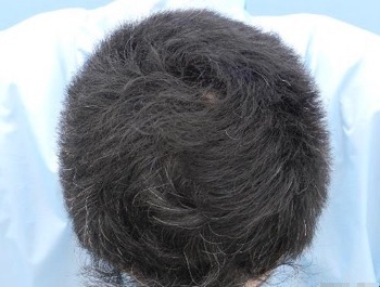 薄毛治療 発毛症例 23歳/O型/6ヶ月後