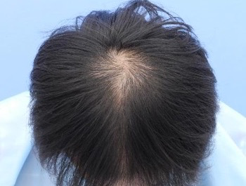 薄毛治療 発毛症例 28歳/O型/初診時
